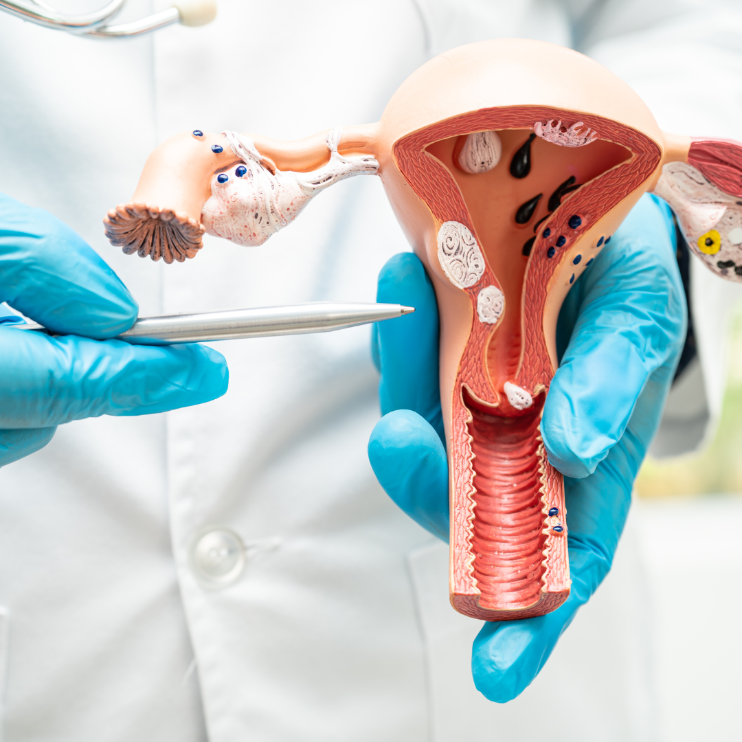 Principais exames para diagnostico e acompanhamento da endometriose e adenomiose